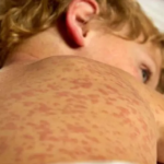 Corrientes refuerza controles y vacunación ante riesgo de sarampión