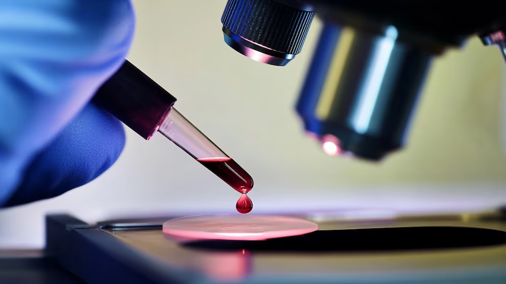 image-2 Día Mundial del Parkinson: una enfermedad que empieza mucho antes que el temblor